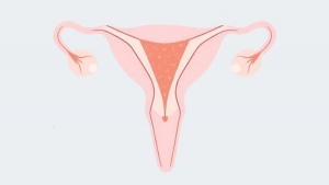 Установка и удаление внутриматочной спирали